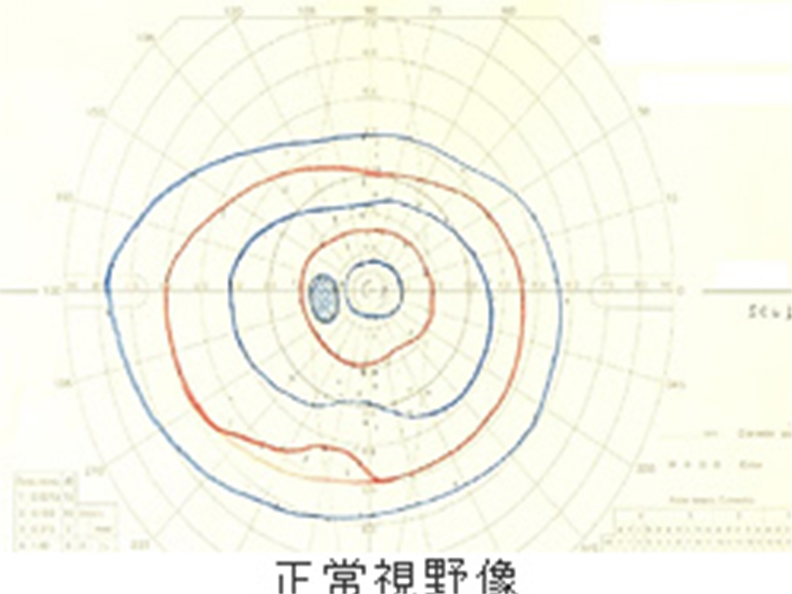 正常視野像