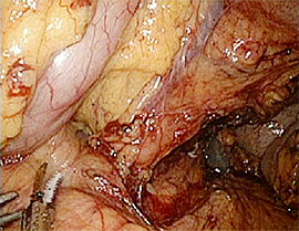 腹腔鏡下噴門側胃切除の実際の手術の写真2