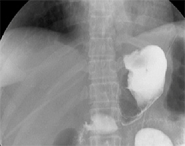 腹腔鏡下噴門側胃切除の実際の手術の写真3