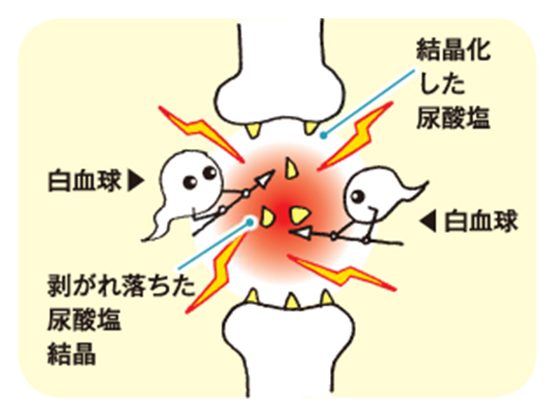 痛風の図説