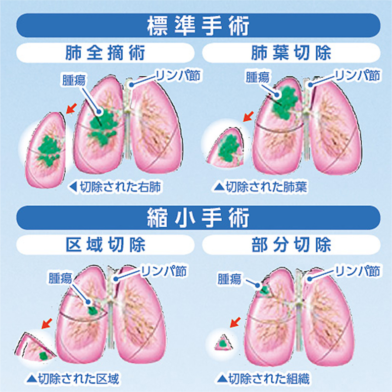 標準手術 縮小手術