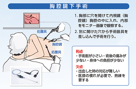 胸腔鏡下手術