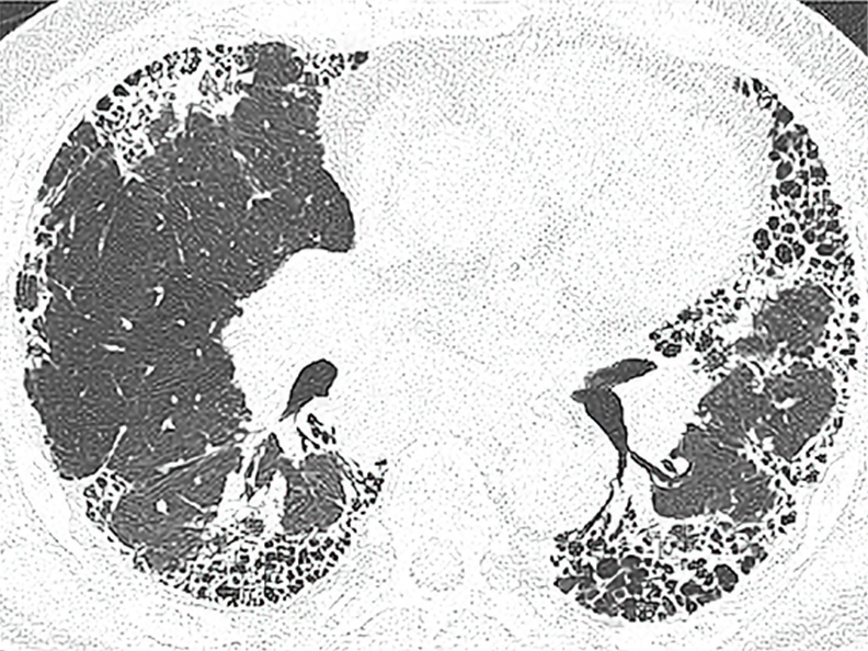 特発性肺線維症の胸部CT所見