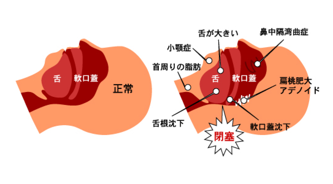 正常な喉と喉が狭くなっている喉