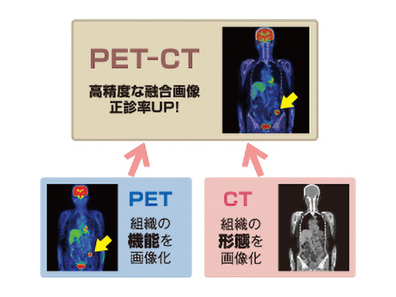 高精度な融合画像 正診率UP