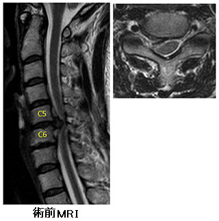 頸椎椎間板ヘルニア症例