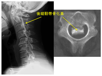 頸椎後縦靭帯骨化症