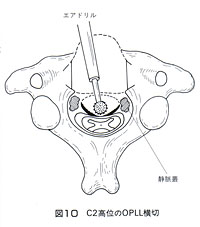 頸椎椎体亜全摘前方除圧固定術