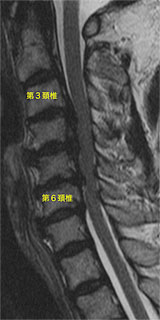 頸椎後縦靭帯骨化症 症例