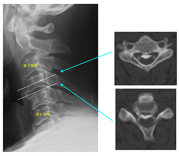 頸椎後縦靭帯骨化症 症例