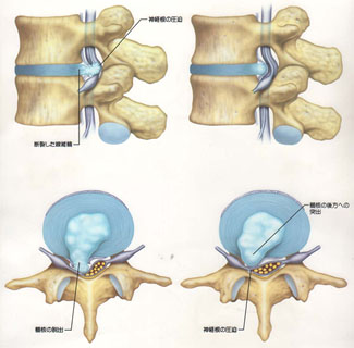 腰椎椎間板ヘルニア