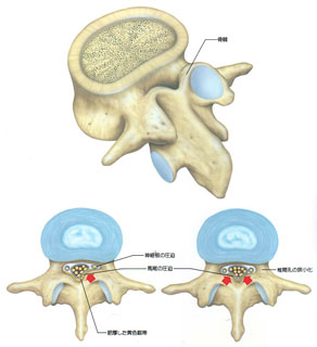 腰部脊柱管狭窄症