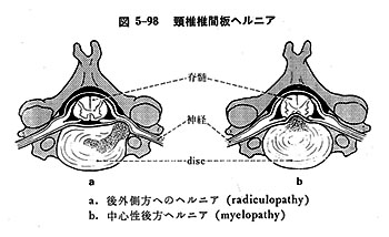 頸椎椎間板ヘルニア