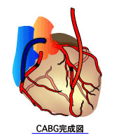 CABG