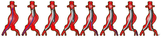 ステントグラフト内挿術（カテーテルによる血管内治療）