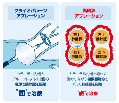 心房細動のカテーテル治療図解