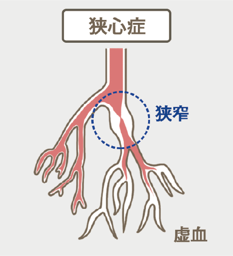 狭心症