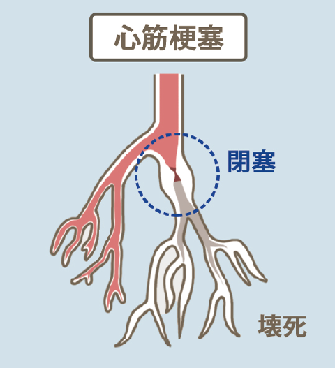 心筋梗塞