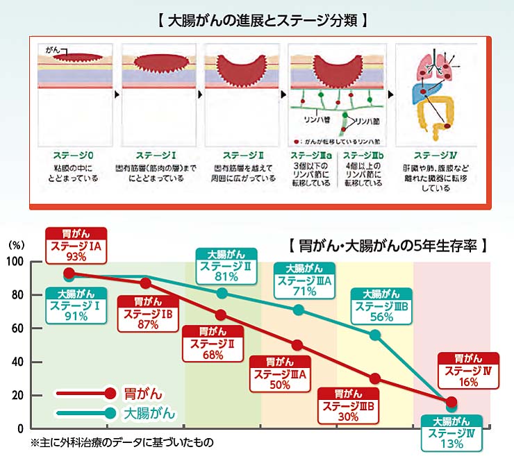 大腸がんの進展とステージ分類 胃がん・大腸がんの5年生存率